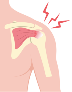 腱板断裂は手術が必要かを解説するイメージ