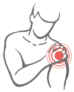 肩インピンジメント症候群