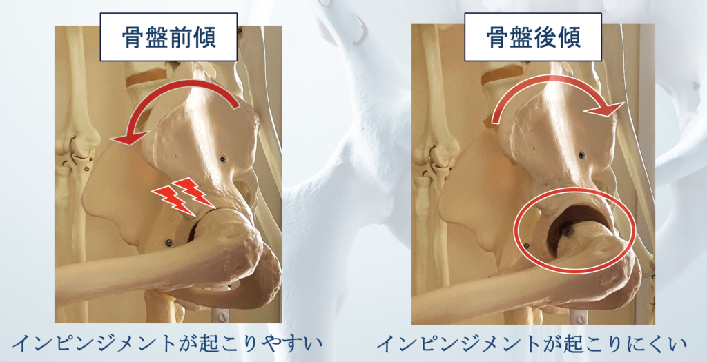 股関節インピンジと骨盤の関係